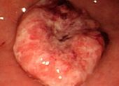 Duodenal ulcer (peptic duodenal)